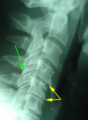 disc degeneration treated at Manahawkin Chiropractic Center