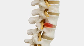 Manahawkin chiropractic conservative care helps even giant disc herniations go away