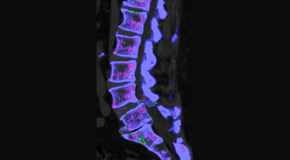 Manahawkin Chiropractic Center is aware that inflammatory spinal gout is a differential diagnosis to consider for patients who present with back pain and other spine related symptoms.