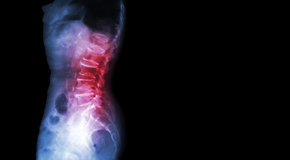 Manahawkin Chiropractic Care of Spondylolisthesis 