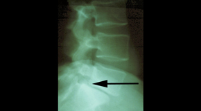 Manahawkin spondylolisthesis 