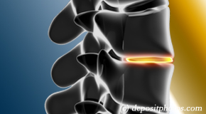 Manahawkin degenerative spinal changes 