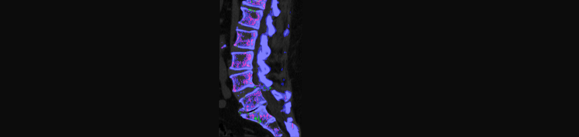 Manahawkin Chiropractic Center is aware that inflammatory spinal gout is a differential diagnosis to consider for patients who present with back pain and other spine related symptoms.