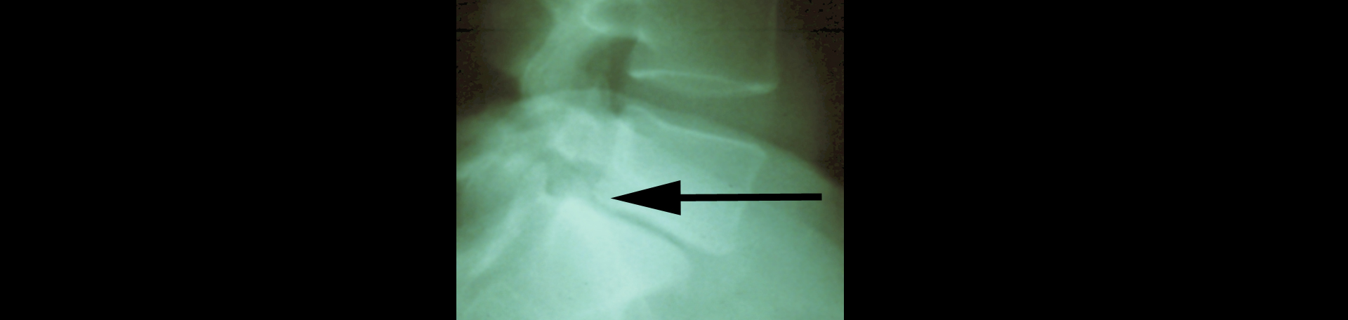 Manahawkin spondylolisthesis