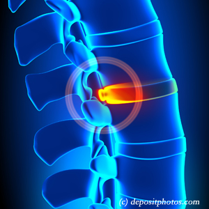 image of lumbar Manahawkin disc herniation