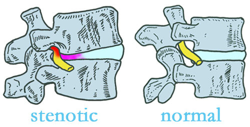 Manahawkin stenotic and normal spinal discs